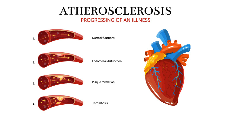 Cause-of-Atherosclerosis