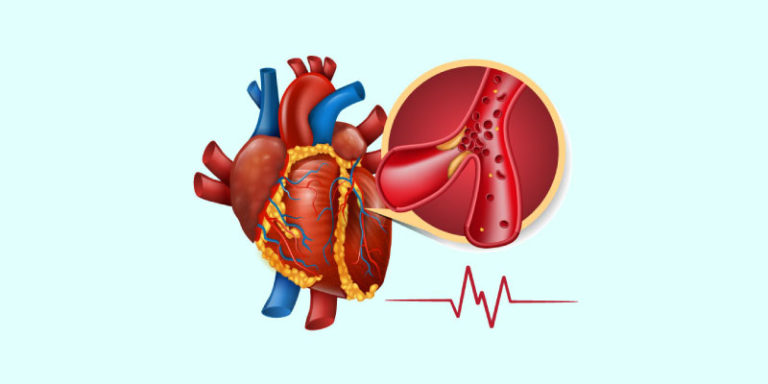 Cardiac Arrest: Symptoms, Causes, and Diagnosis - heartathon.com