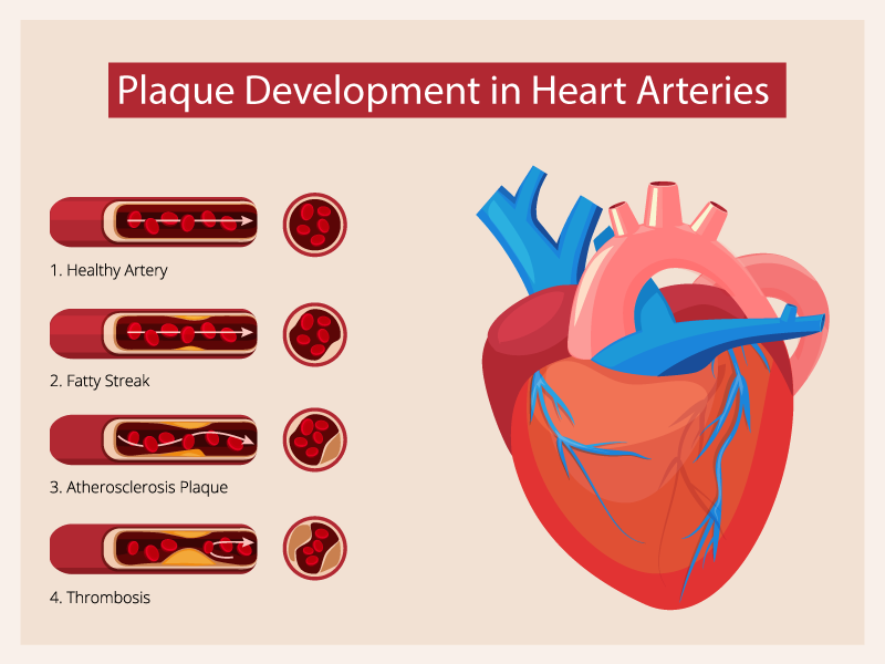 Causes-of-Heart-Attack