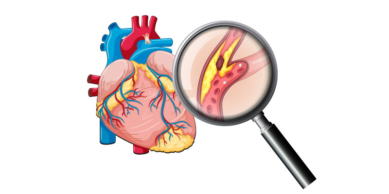 Causes-of-Coronary-Artery-Disease