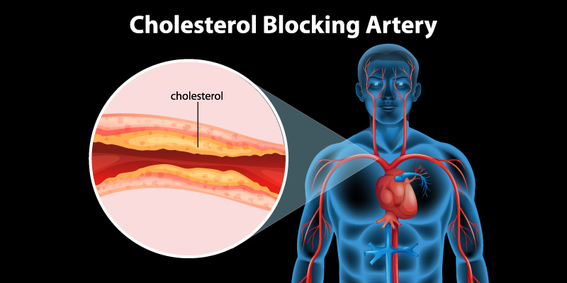 Causes-of-high-cholesterol